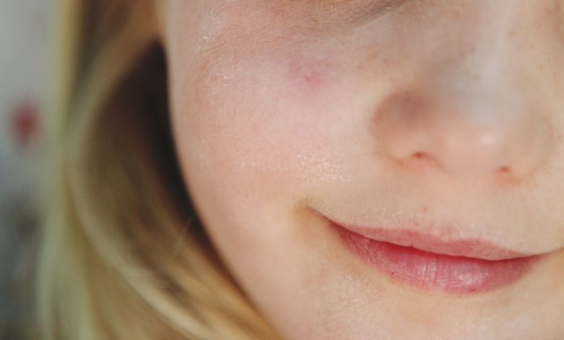 skin-care-for-kids-with-sensitive-skin-how-to-help-chapped-skin